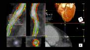 An example of CT imaging coronary plaque assessment on TeraRecon's advanced visualization software.