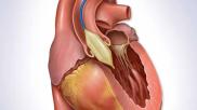 Balloon valvuloplasty months after implantation is a safe and effective treatment option for patients with transcatheter heart valve (THV) dysfunction, according to a new analysis published in the Journal of the American College of Cardiology