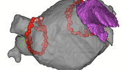 Pulmonary vein isolation (PVI) using higher power energy ablation was found to be safe, more effective and was able to cut procedure time, but there was a signal of increased emboli.