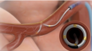 Renal denervation is associated with improved blood pressure (BP) control and a reduced risk of adverse cardiovascular outcomes, according to two late-breaking clinical trials presented at EuroPCR 2022 in Paris. Both clinical trials focused on three-year data related to Medtronic’s Symplicity Spyral Renal Denervation (RDN) System, which was designed to lower BP through the use of a curling catheter that ablates overactive nerves.