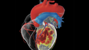 inHEART Medical, an international healthcare company with offices in France and the United States, has received clearance from the U.S. Food and Drug Administration (FDA) for its new 3D visualization software designed to improve the management of ventricular tachycardia (VT) ablation and other cardiac ablation procedures.