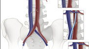 The steps involved to gain transcaval access between the inferior vena cava and the aorta to avoid problematic anatomical areas that would have otherwise disqualified a patient for a femoral access TAVR procedure. Illustration of the NIH