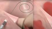 Early clinical evaluation of the Alleviant System to create no-implant interatrial shunts to treat heart failure patients with preserved and reduced ejection fraction (HFpEF and HFrEF) demonstrated procedural safety and feasibility with a promising efficacy signal through six months. 