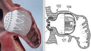 Two examples of new left atrial appendage occluders (LAAO), the Conformal omn left and the Laminar on the right. evi Nair, MD, FACC, FHRS, director of cardiac electrophysiology at St. Bernard's Healthcare, Jonesboro, Arkansas, explains some of the recent advances in transcatheter left atrial appendage (LAA) occlusion technology at the 2022 Transcatheter Valve Therapeutics (TVT) Structural Heart Summit. #TVT #TVT2020 #LAA #LAAO #EPeeps