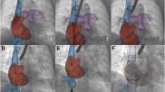 TricValve Transcatheter Bicaval Valves System P+F Products + Features GmbH