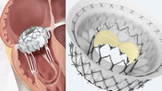 Mitral and_tricuspid transcatheter valves Evoque and Intrepid were discussed at TVT 2022.