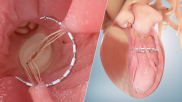 Ancora Heart AccuCinch Ventricular Restoration System heart failure FDA 