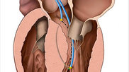 Adam Greenbaum, MD, transcatheter electrosurgery to prevent left ventricular outflow tract (LVOT) obstruction using a new procedure called Septal Scoring Along the Midline Endocardium (SESAME). The transcatheter procedure mimicking surgical myotomy.