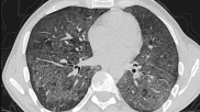 Lung CT of a 42-year-old man with more than 7 days of symptoms. Scans show COVID pneumonia with diffuse ground-glass opacities in close vicinity of visceral pleural surfaces. In addition, a crazy paving pattern is observed. Image courtesy of RSNA. Medical images of COVID. #COVID #SARS-CoV-2