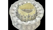 The Abbott Cephea transcatheter mitral valve replacement (TMVR) system. 