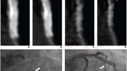 coronary CTA