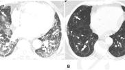 long covid lung CT