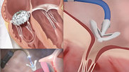 Three transcatheter tricuspid valve repair and replacement (TTVR) technologies that will likely see FDA clearance in. the next couple years include the Edwards Evoque transcatheter tricuspid valve (top left), Abbott TriClip (below) and the Edwards Lifesciences Pascal clip device (right).