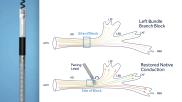 The Medtronic SelectSecure MRI SureScan Model 3830 cardiac lead already gained FDA approval for His-Bundle pacing back in 2018. Now, the lead is also approved for left bundle branch area pacing, providing users with another option when treating patients for bradycardia. According to Medtronic, this marks the first time the FDA has approved a device for this indication.