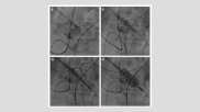 A team of cardiologists and cardiac surgeons in Hong Kong has performed the first successful undermining iatrogenic coronary obstruction with radiofrequency needle procedure—or UNICORN for short—on a high-risk valve-in-valve transcatheter aortic valve replacement (TAVR) patient. The group wrote about their experience in Circulation: Cardiovascular Interventions, a journal launched and distributed by the American Heart Association.