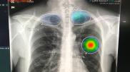 Example of AI automated detection highlighting critical lung findings on a chest X-ray. Example shown by AI vendor Lunit.