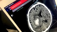 An example of artificial intelligence (AI) automated detection of a intracranial hemorrhage (ICH) in. a CT scan used to send alerts to the stroke acute care team before a radiologist even sees the exam. Example shown by TeraRecon at RSNA 2022.