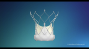 Abbott has gained U.S. Food and Drug Administration (FDA) approval for its Navitor transcatheter aortic valve replacement (TAVR) system, the company’s new Navitor self-expanding valve for high-risk patients with severe symptomatic aortic stenosis. 