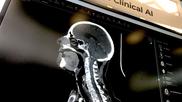 Brain imaging artificial intelligence is a primary area of concentration for AI because oif the critical nature of fast detection and treatment for patients. This is an example of the AI applications displayed by third-party advanced visualization vendor TeraRecon at RSNA 2022.