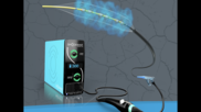 Shockwave L6 Peripheral IVL Catheter Shockwave Medical 