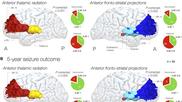 brain connections that cause epileptic seizures