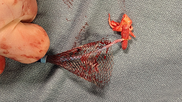 Mitral Valve Surgery from the University of Washington 