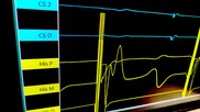CathVision ECGenius high fidelity EP recording system showing His bundle pacing demo at HRS 2023. Photo by Dave Fornell