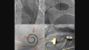 The Wattson temporary pacing guidewire from Teleflex