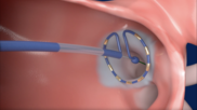 Medtronic's PulseSelect Pulsed Field Ablation (PFA) System 