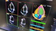 Example of a totally AI driven echocardiography workflow on the new Siemens Origin ultrasound system unveiled in 2023. The AI did all the work on this screen, taking a 3D echo exam and automatically segmenting the anatomy, contoured all the chambers, found the ideal views to display and then calculated all the measurements in seconds. Photo by Dave Fornell at TCT 2023. 