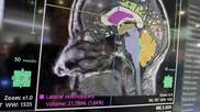 Brain MRI AI assessment and segmentation on Fujifilm's Synapse system at RSNA 2023. Photo by Dave Fornell. #RSNA #RSNA23 #RSNA2023