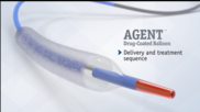 Boston Scientific has received U.S. Food and Drug Administration (FDA) approval for its Agent Drug-Coated Balloon (DCB) for the treatment of coronary in-stent restenosis (ISR) in patients with coronary artery disease. 