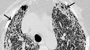 interstitial lung disease reporting data system