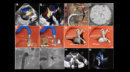 An 86-year-old patient is showing signs of improvement six months after receiving the world’s first implant of a new-look medical device for treating tricuspid regurgitation (TR), according to new data published in JACC: Cardiovascular Interventions.[1] The device in question, the Tricuspid Flow Optimizer, was developed by Triflo Cardiovascular, a U.S.-based biomedical company founded in 2017 by a team of structural heart specialists. 