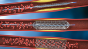 PCI interventional cardiology. The use of radial access during PCI procedures is increasing throughout the United States, and new data presented at the SCAI's annual meeting suggest that could be beneficial for patients. 