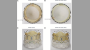 Edwards Lifesciences Sapien 3 Ultra Resilia TAVR