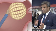 Vivek Reddy, MD, Director, Cardiac Arrhythmia Service, and the Leona M. and Harry B. Helmsley Charitable Trust Professor of Medicine in Cardiac Electrophysiology, at Mount Sinai in New York, was involved in most of the late-breaking pulsed field ablation (PFA) trials at the Heart Rhythm Society (HRS) 2024 meeting. He offers an overview of the new data presented and his observations from using PFA. #HRS24 #HRS2024 #PFA #EPeeps