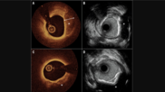 Images coronary calcium imaging by optical coherence tomography (OCT) and high-definition intravascular ultrasound (IVUS). 