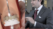 Philippe Genereux explains how EARLY TAVR will help raise awareness for undertreatment of TAVR.