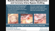 In October 2024, heart surgeons with the WVU Heart and Vascular Institute in Morgantown, West Virginia, performed the world’s first robotic aortic valve replacement and coronary artery bypass (RAVCAB) procedure. Now, the team behind that historic surgery has shared its full story for the first time, publishing an in-depth look at the procedure in The Annals of Thoracic Surgery, an official journal from the Society of Thoracic Surgeons. Graphic and images courtesy of Badhwar et al. and the STS.