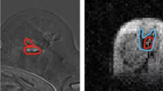 Images from traditional breast MRI (left) compared to FCI scanner images (right). Courtesy of University of Aberdeen.