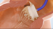 Capstan Medical robotic transcatheter mitral valve replacement. Capstan Medical, a California-based medtech company focused on developing new structural heart disease treatments, announced the news, noting that its robotic-enabled technologies were used to complete two successful robotic TMVR procedures at Hospital Clínico Universidad Católica in Santiago, Chile.