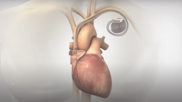 Orchestra BioMed Holdings AVIM Therapy FDA breakthrough device