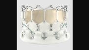 The balloon-expandable Myval transcatheter aortic valve replacement (TAVR) valve is associated with positive real-world data after four years.