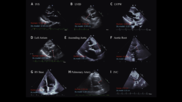 Cardiologists have developed an open-source artificial intelligence (AI) model capable of accurately evaluating a long list of measurements on echocardiography results. The group detailed the development and validation of that model in the Journal of the American College of Cardiology. A comparison of measurements made by a sonographer (in red) and predictions from the deep learning model (in light blue) across 9 echocardiographic parameters. Image and caption courtesy of Ouyang et al., JACC.