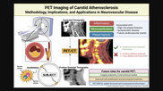Positron emission tomography (PET) nuclear imaging has seen rapid expansion in cardiology and oncology due to its improve accuracy over SPECT and its ability to expand into new areas of cardiovascular imaging. A new review in the American Heart Association journal Stroke outlines another possible use of PET to assess carotid artery atherosclerosis for stroke prevention. Figure courtesy Stroke, https://www.ahajournals.org/doi/10.1161/STROKEAHA.125.050399