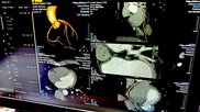  The Society of Cardiovascular Computed Tomography (SCCT) this week released a new expert consensus document on interpretation and reporting of coronary CT angiography (CCTA). The update replaced the 2014 guidance and incorporates advances in scanner technology, image reconstruction, plaque assessment and revised standardized reporting incorporating CAD-RADS 2.0. Image in Philips booth at RSNA 2025, photo by Dave Fornell.