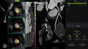 cvi42 | Plaque Circle Cardiovascular Imaging
