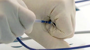 Pulse Biosciences nPulse nanosecond pulsed field ablation (nsPFA) system uses 5‑second applications to create lesions and does not require catheter repositioning.
