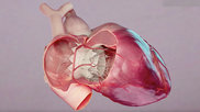 The U.S. Food and Drug Administration (FDA) has approved an investigational device exemption (IDE) to conduct a pivotal clinical trial for TRiCares Topaz transcatheter tricuspid valve replacement (TTVR) system in the U.S. The TTVR system uses two stent frames, one for the valve and one to engage the annulus with a membrane shirt between them to enable flexing of the outer ring to better seal against regurgitation.expansing stents 